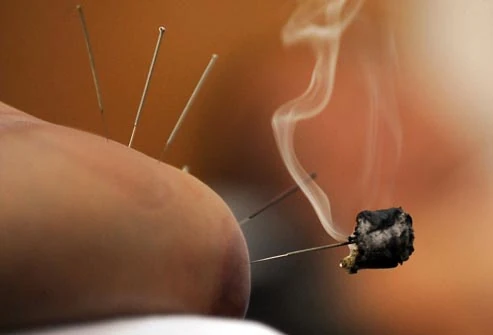 Moxibustion treatment with acupuncture in Cape Town